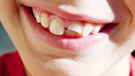 شکستگی و ترک خوردن دندان: ترمیم و درمان