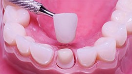  انواع روکش دندان و بریج: مراحل، قیمت،مزایا و عوارض