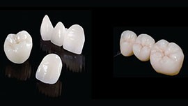 روکش های تمام سرامیکی دندان: انواع، مزایا و هزینه آن